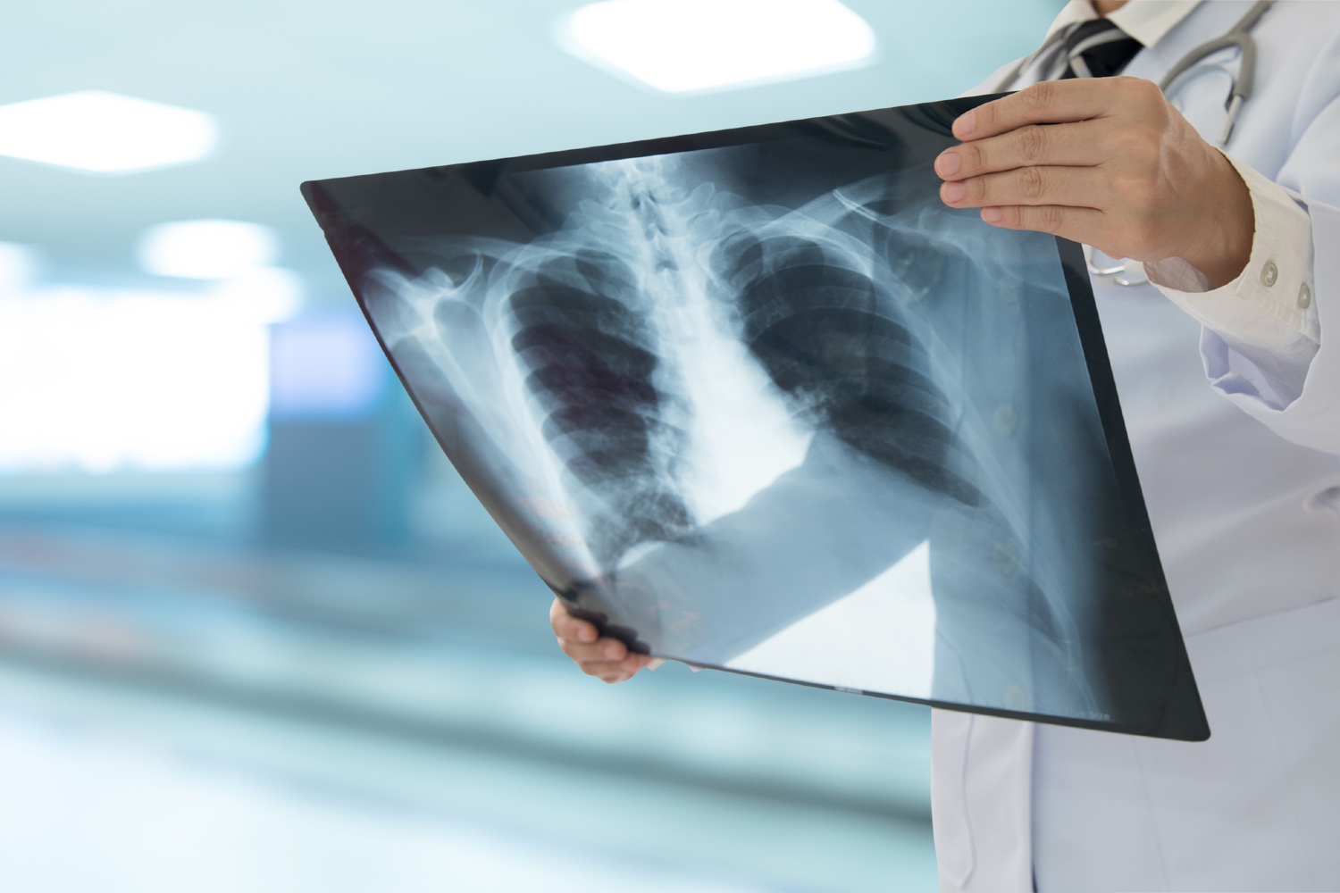 Clearing ‘immune fog’ could stop lung cancer before diagnosis – UKRI